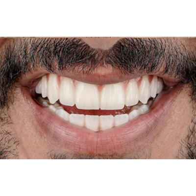 Full Mouth Rehab After